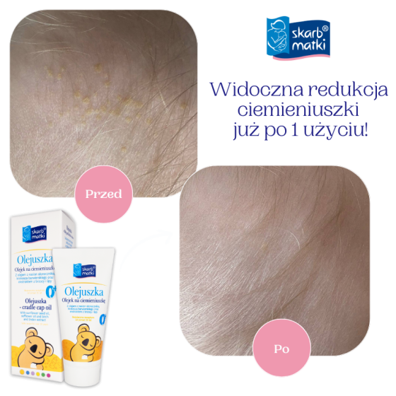 Olejuszka olejek na ciemieniuszkę 30 ml / Skarb Matki